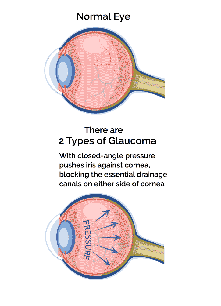 glaucoma signs